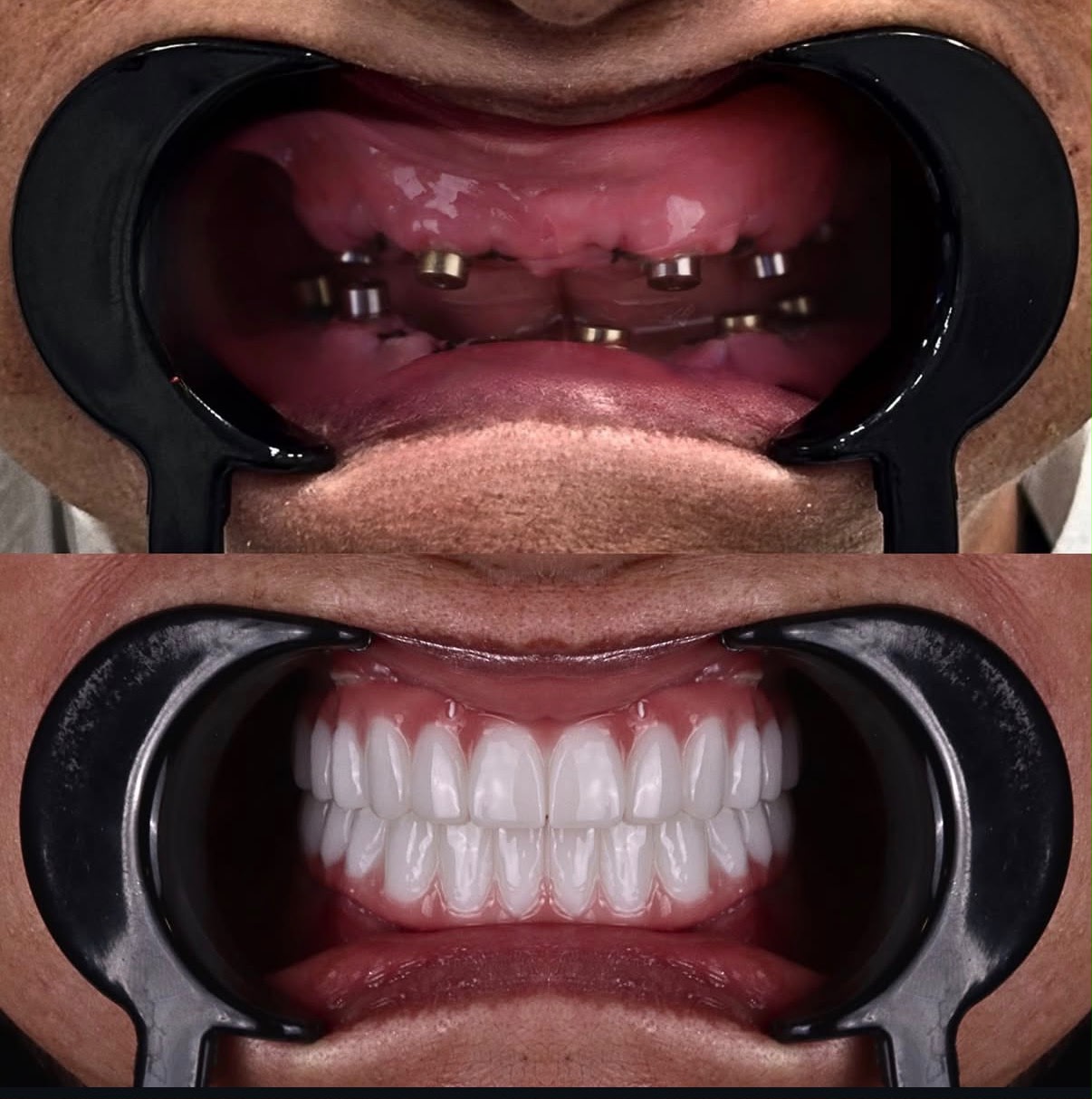 Dental Implants result – Patient 3 · Dr. Mervan Dental Clinic