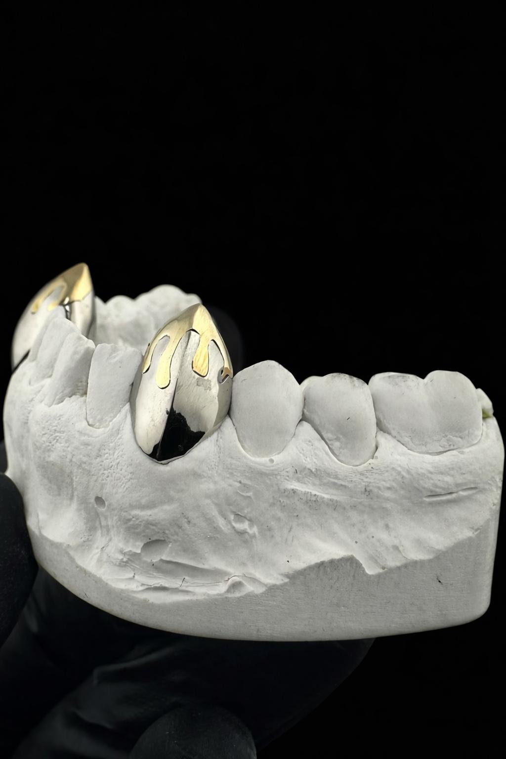 Gold Fang Grillz · Dr. Mervan Dental Clinic