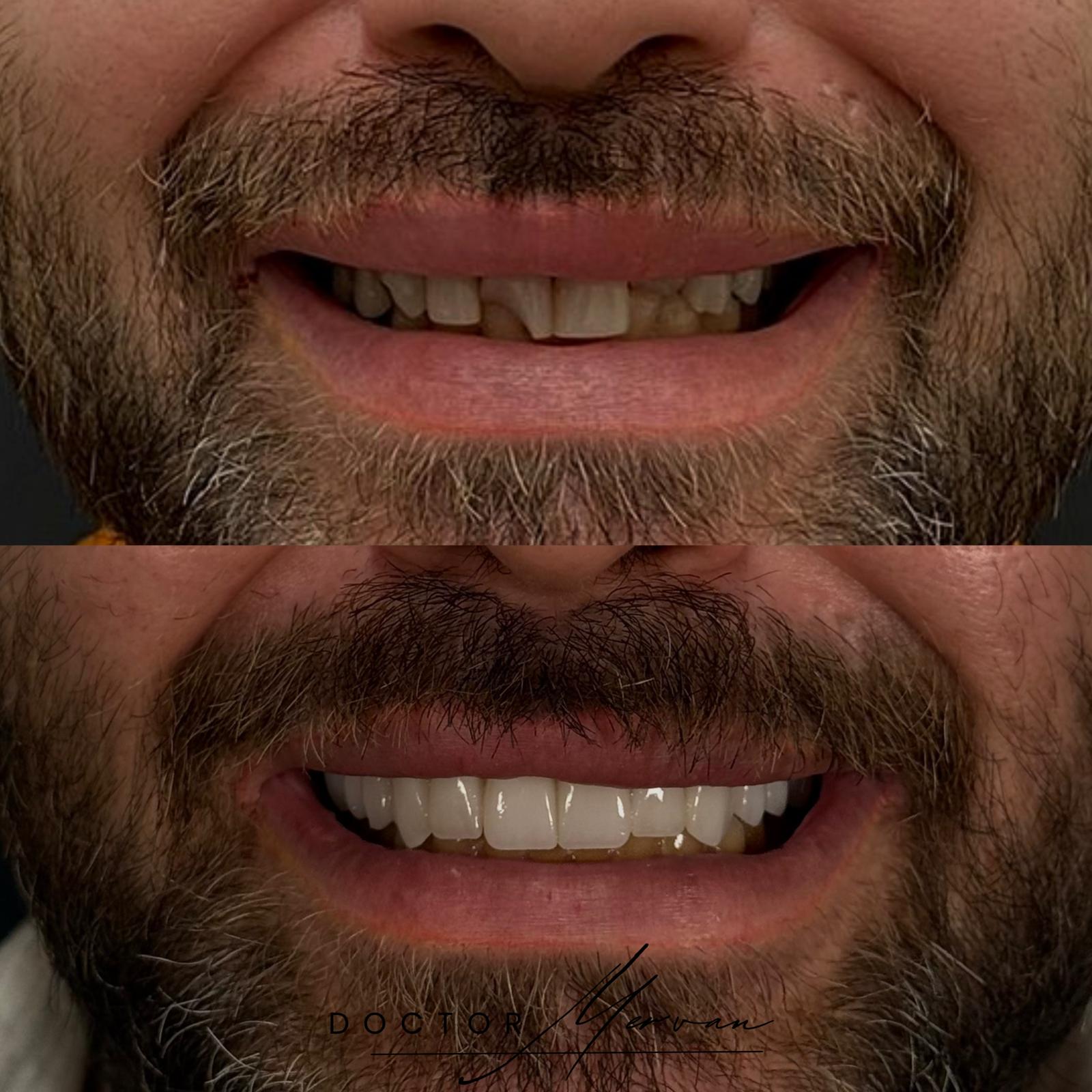 Laminate Veneers result – Patient 2 · Dr. Mervan Dental Clinic