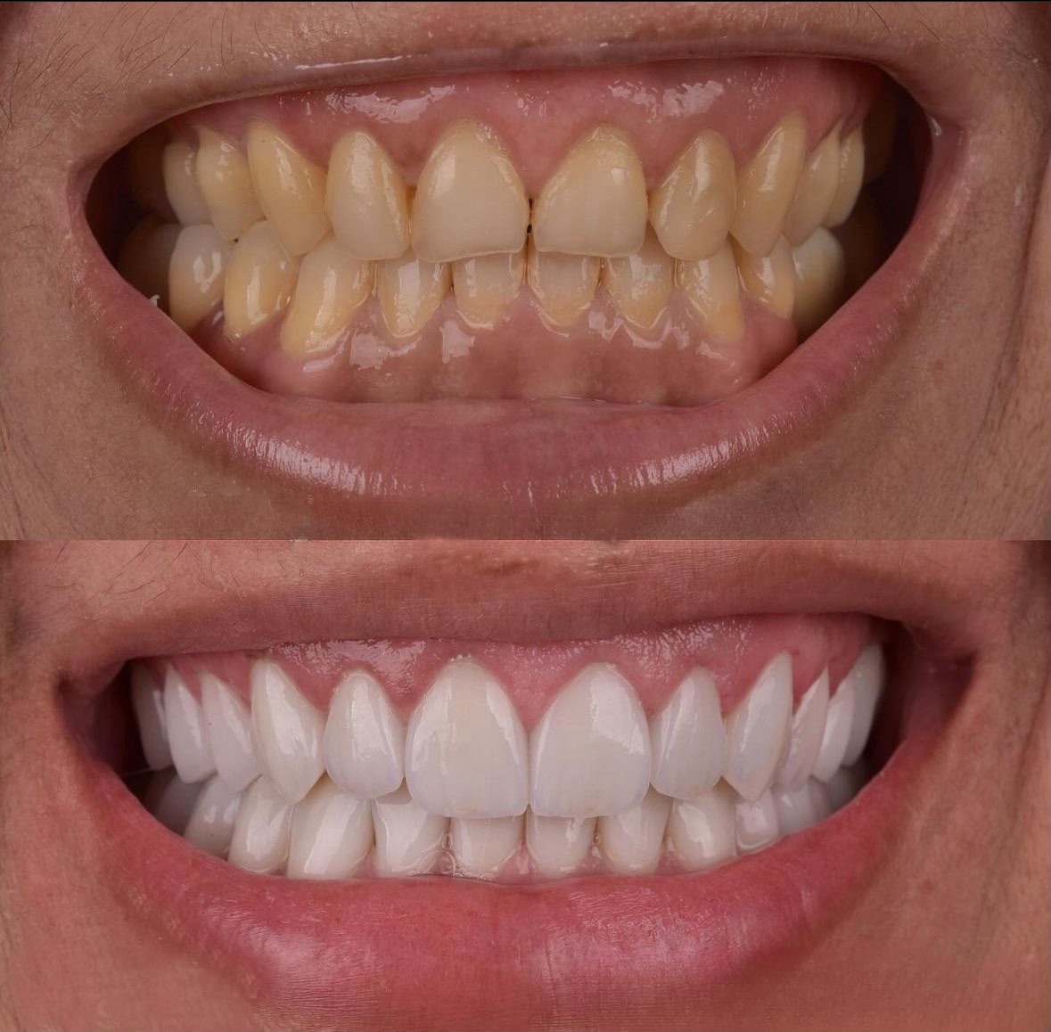 Laminate Veneers result – Patient 4 · Dr. Mervan Dental Clinic