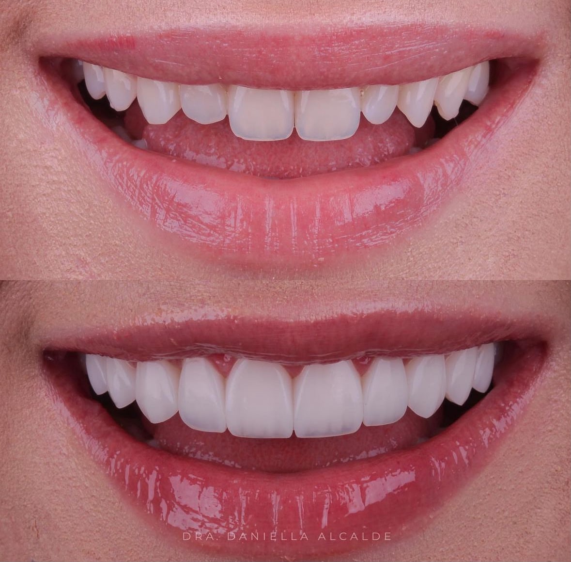 Zirconia Crowns result – Patient 3 · Dr. Mervan Dental Clinic