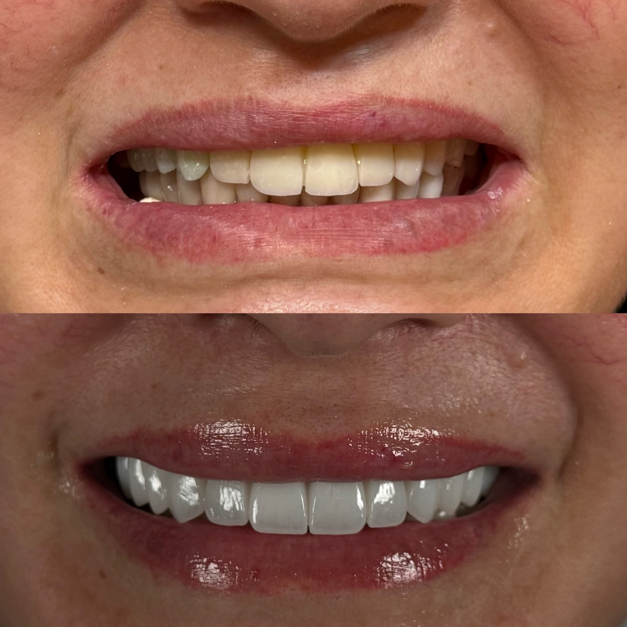 Zirconia Crowns result – Patient 4 · Dr. Mervan Dental Clinic
